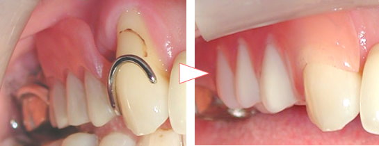 保険義歯→スマイルデンチャーのビフォーアフター