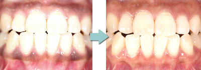 ガムピーリング