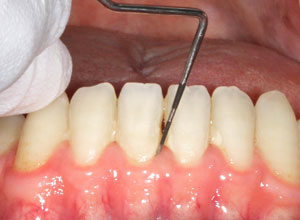 歯周組織検査